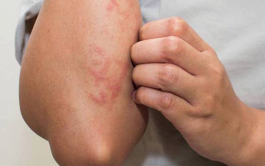 پورفیری چیست و چه علائمی دارد؟ (2 نکته مهم) پورفیری چیست و چه علائمی دارد؟ (2 نکته مهم)