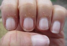 پوسته پوسته شدن اطراف ناخن نشانه چیست ؟ (2 نکته مهم)