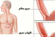 چرا مری ملتهب می شود؟ (2 نکته مهم)