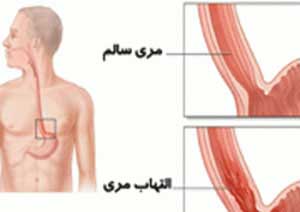 چرا مری ملتهب می شود؟ (2 نکته مهم)