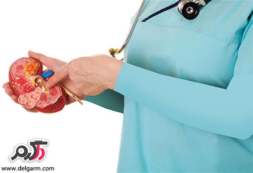چرا کلیه سنگ میسازد؟ (2 نکته مهم) چرا کلیه سنگ میسازد؟ (2 نکته مهم)