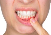 چه عواملی باعث ایجاد پریودنتیت می شود؟ (2 نکته مهم)