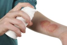 چگونه درد و سوزش ناشی از سوختگی را کاهش دهیم؟ (2 نکته مهم)