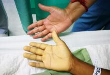 کم‌خونی ناشی از کمبود اسید فولیک چیست و چگونه درمان میشود ؟ (2 نکته مهم)