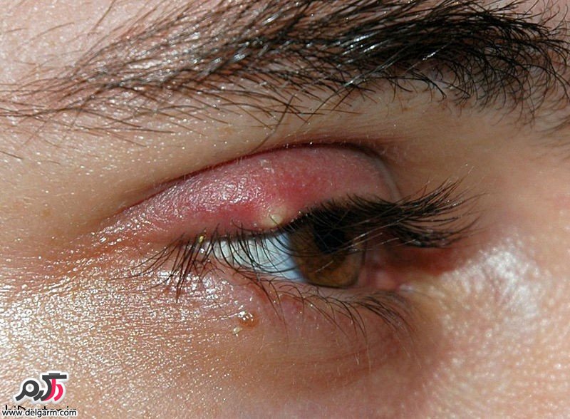 گل مژه(Hordeolum) چیست؟ راه های درمان گل مژه روی پلک چیست؟ (2 نکته مهم)