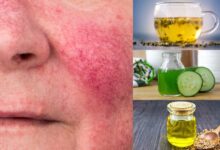 ۲۷ راه حل خانگی برای درمان بیماری روزاسه (Rosacea) (2 نکته مهم)