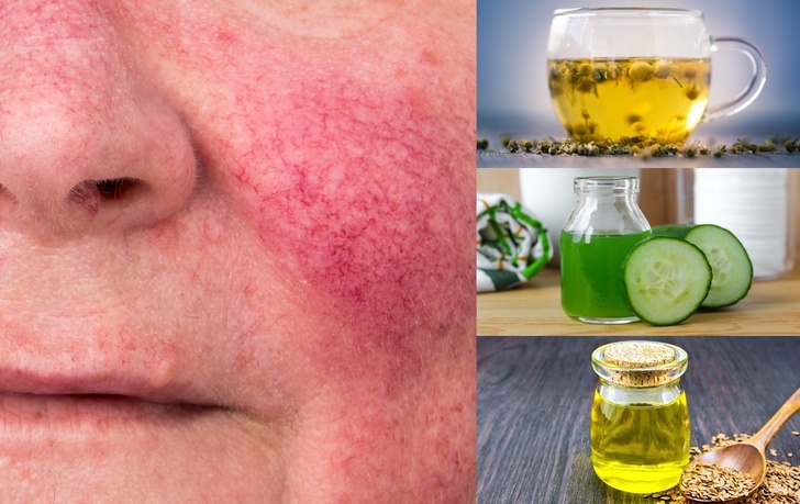 ۲۷ راه حل خانگی برای درمان بیماری روزاسه (Rosacea) (2 نکته مهم) ۲۷ راه حل خانگی برای درمان بیماری روزاسه (Rosacea) (2 نکته مهم)