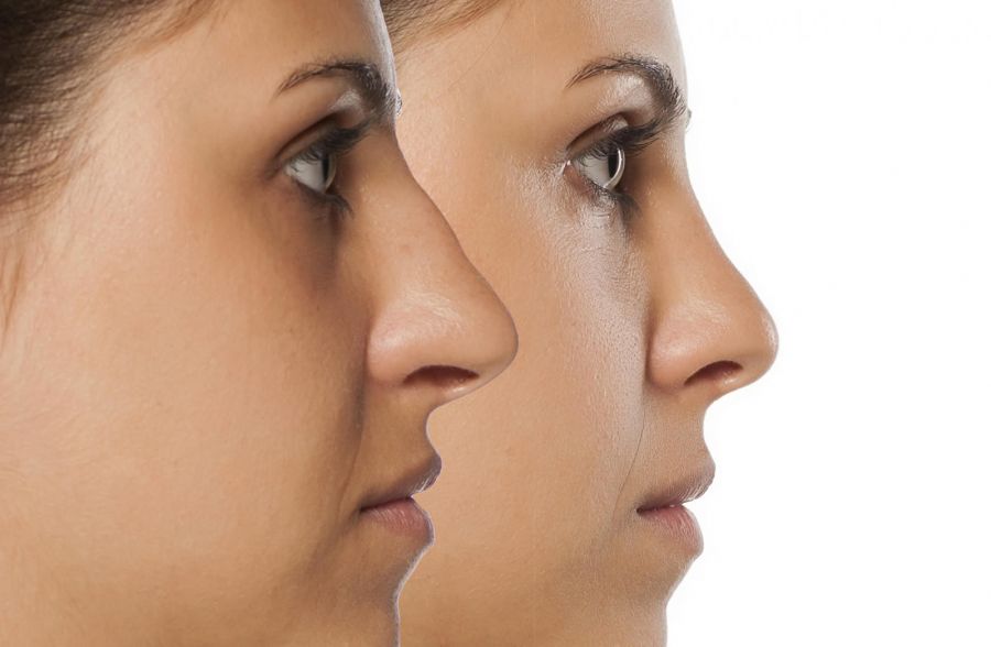 آیا جراحی بینی با لیزر موفقیت آمیز است؟ (2 نکته مهم)