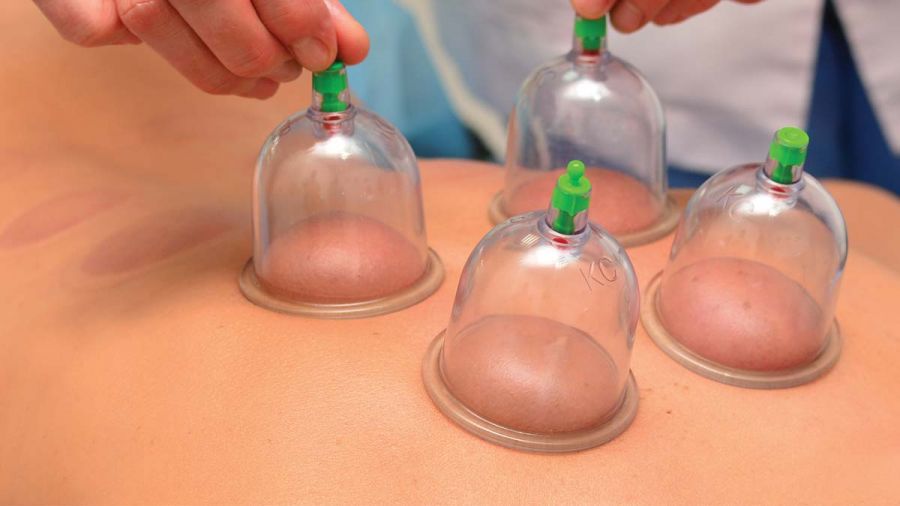 آیا حجامت برای بدن مفید است ؟ (2 نکته مهم)