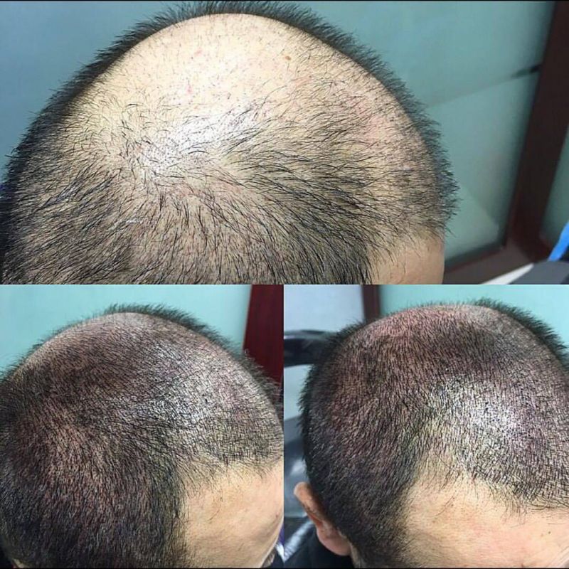 اسکالپ سر چیست؟ آیا عمل میکرو اسکالپ خطرناک است؟ (2 نکته مهم)