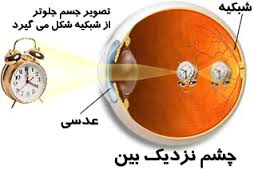 اطلاعات مورد نیاز شما درمورد عیوب انکساری چشم یا همان تار دیدن  (2 نکته مهم)