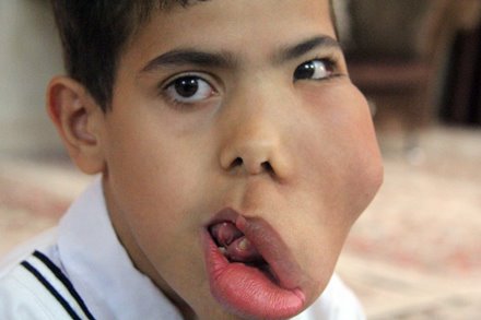 تنها آرزوی این پسربچه مداوای صورتش است (2 نکته مهم)