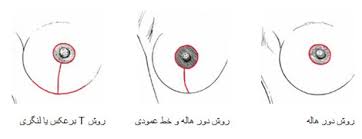 لیزر و لیپولیز و جراحی سینه