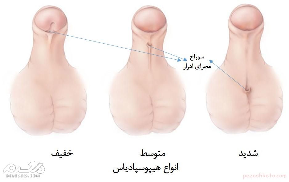 انواع هایپوسپادیاس