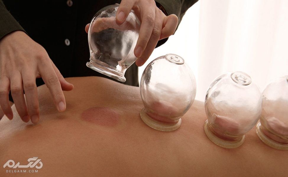 بادکش درمانی در طب سنتی