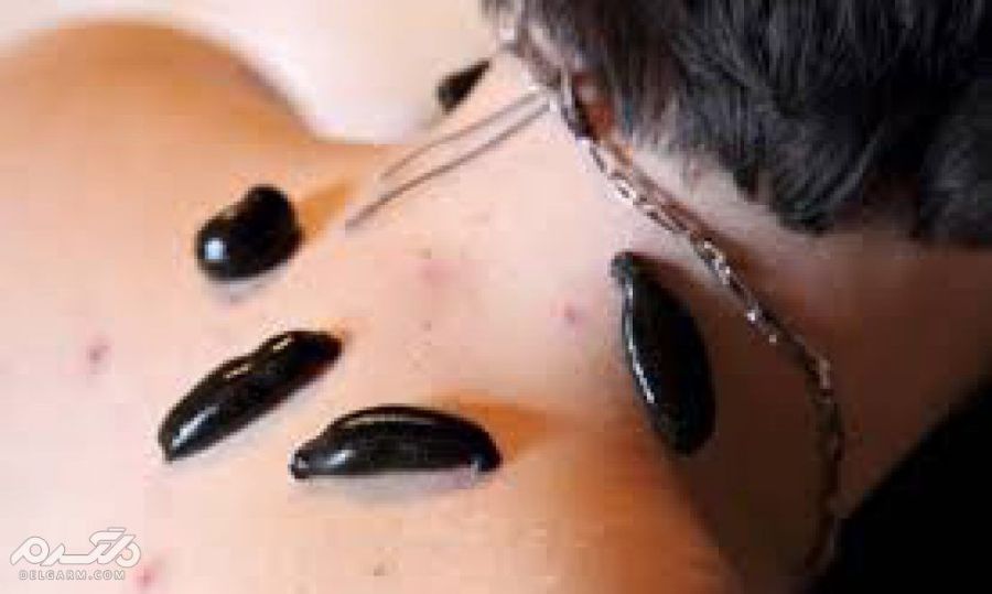 زالو درمانی در طب سنتی