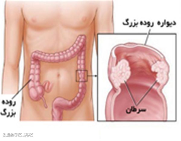 آب آلو سیاه برای سرطان روده بزرگ