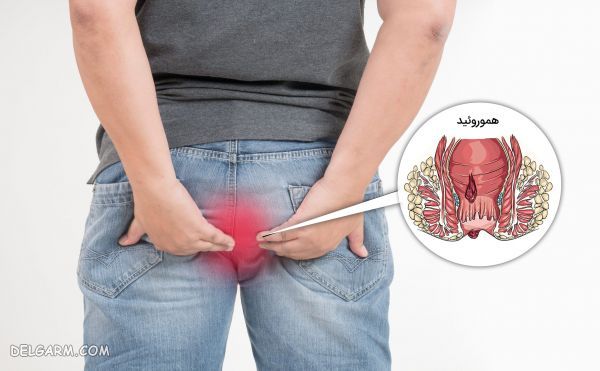 موم عسل برای بواسیر