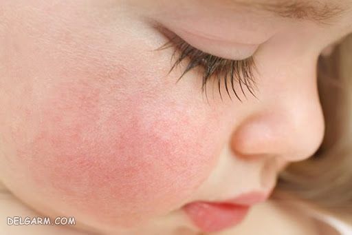 علائم حساسیت به موز