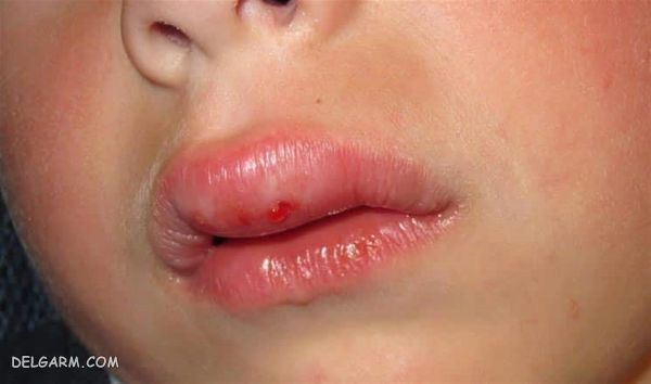 علائم حساسیت به موز