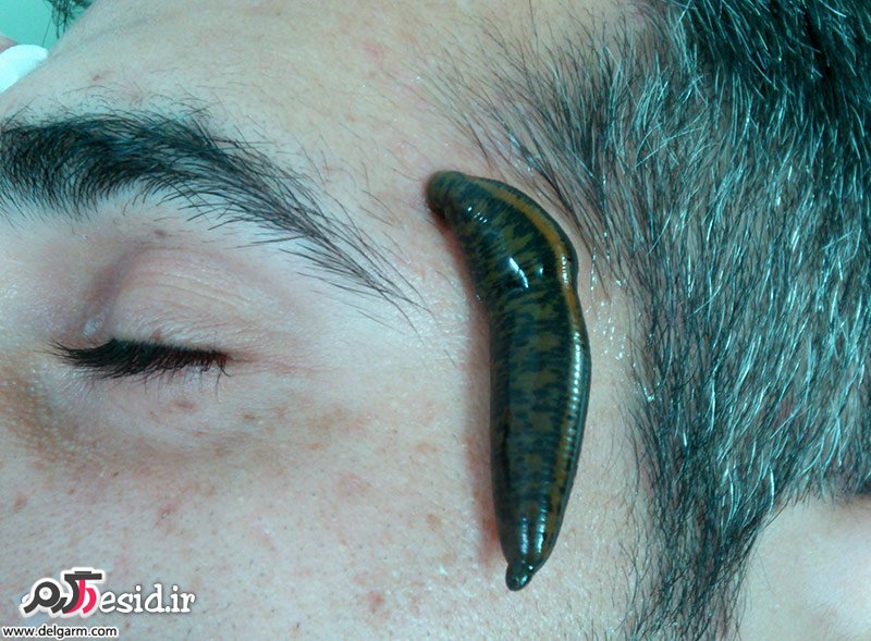 فواید زالو درمانی