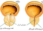پروستات را با این شیرینی درمان کنید  (2 نکته مهم)