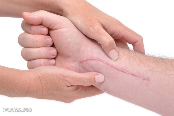 برای زود خوب شدن بخیه چه بخوریم