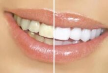 14 راهکار طب سنتی برای دهان و دندان های شما (2 نکته مهم)