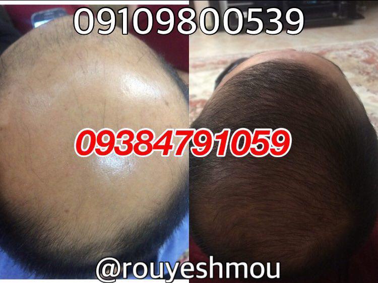 همه چیز درمورد دکتر نوروزیان وپکیج رویش مجدد مو