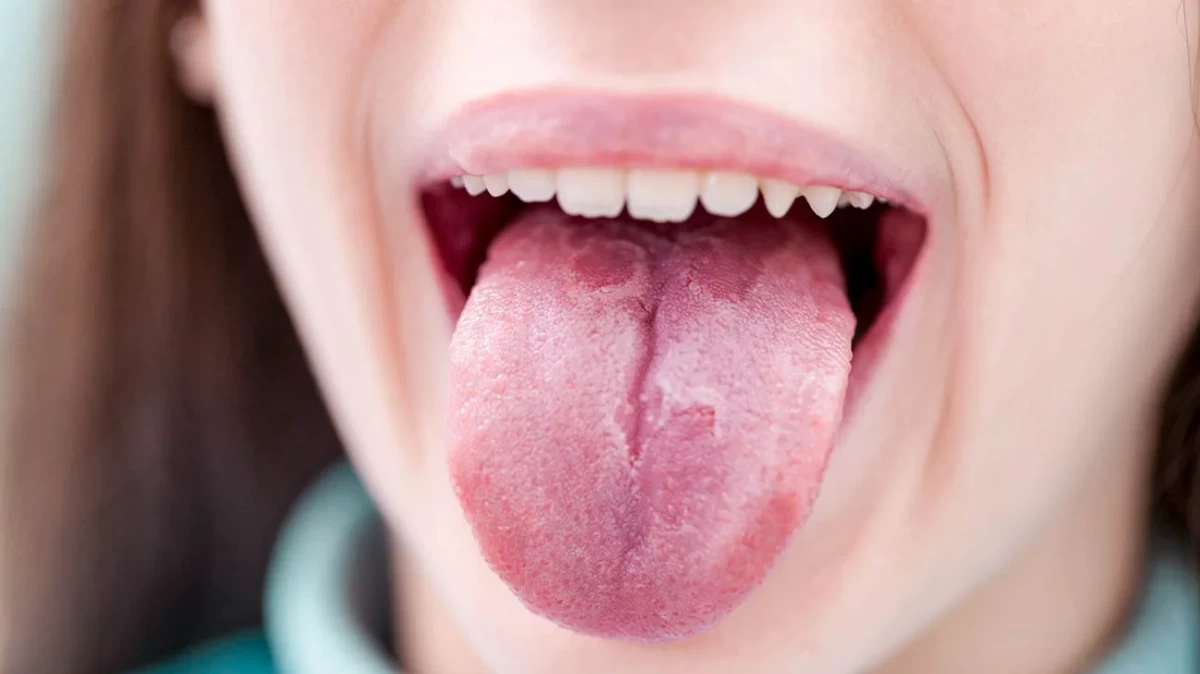 بررسی دلایل ایجاد ترک خوردن زبان (2 نکته مهم)