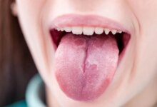 بررسی دلایل ایجاد ترک خوردن زبان (2 نکته مهم)