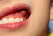 کیست دندان / برای درمان آن چکار باید کرد؟ (2 نکته مهم)
