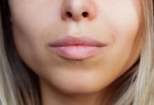 مراقبت‌ های بعد از بوکال فت: از جراحی تا بهبودی! (2 نکته مهم)