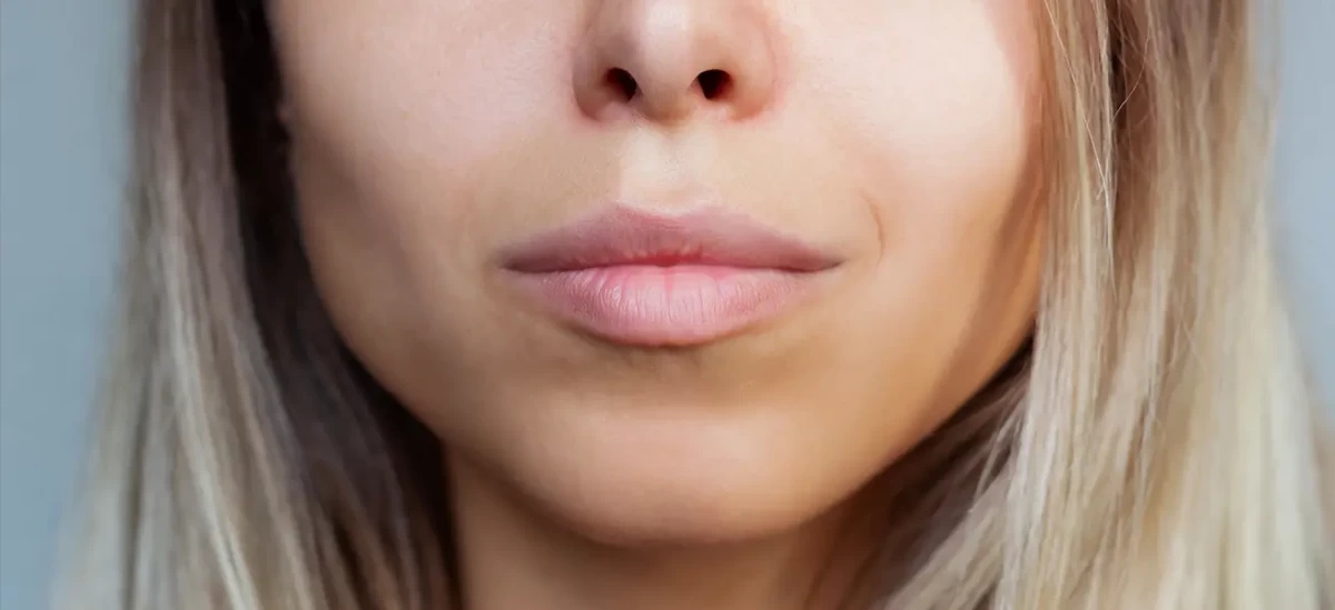 مراقبت‌ های بعد از بوکال فت: از جراحی تا بهبودی! (2 نکته مهم)