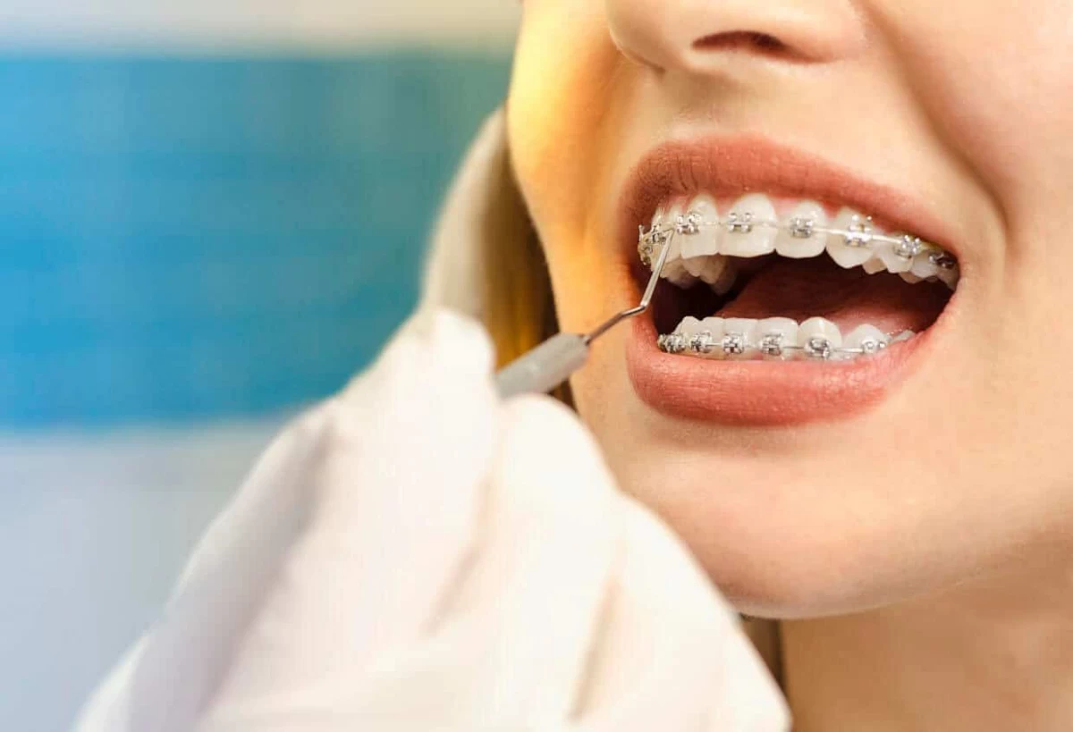 همه چیز درباره مقایسه‌ ارتودنسی سرامیکی و فلزی (2 نکته مهم)