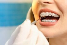 همه چیز درباره مقایسه‌ ارتودنسی سرامیکی و فلزی (2 نکته مهم)