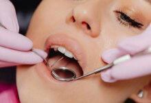 مزایای جرم گیری پشت دندان و تاثیر آن بر سلامت دندانها (2 نکته مهم)