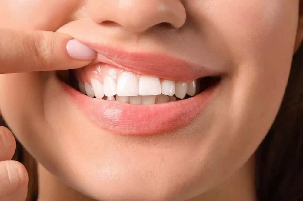 مراقبت بعد از لیفت لثه