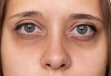 آنچه باید در مورد علائم تیروئید چشمی و راه حل آن بدانید! (2 نکته مهم)