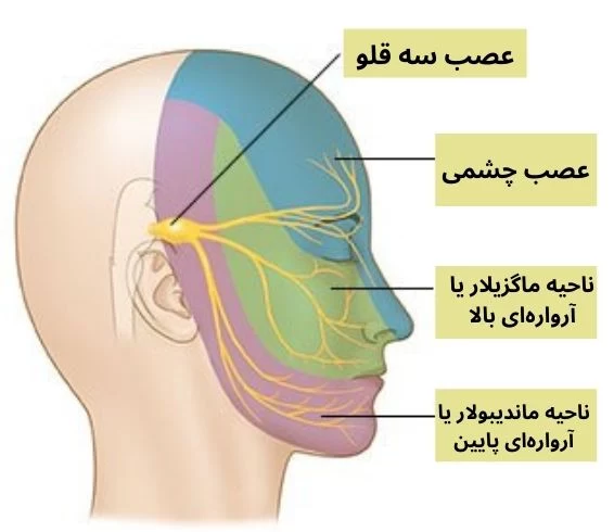 میگرن 
