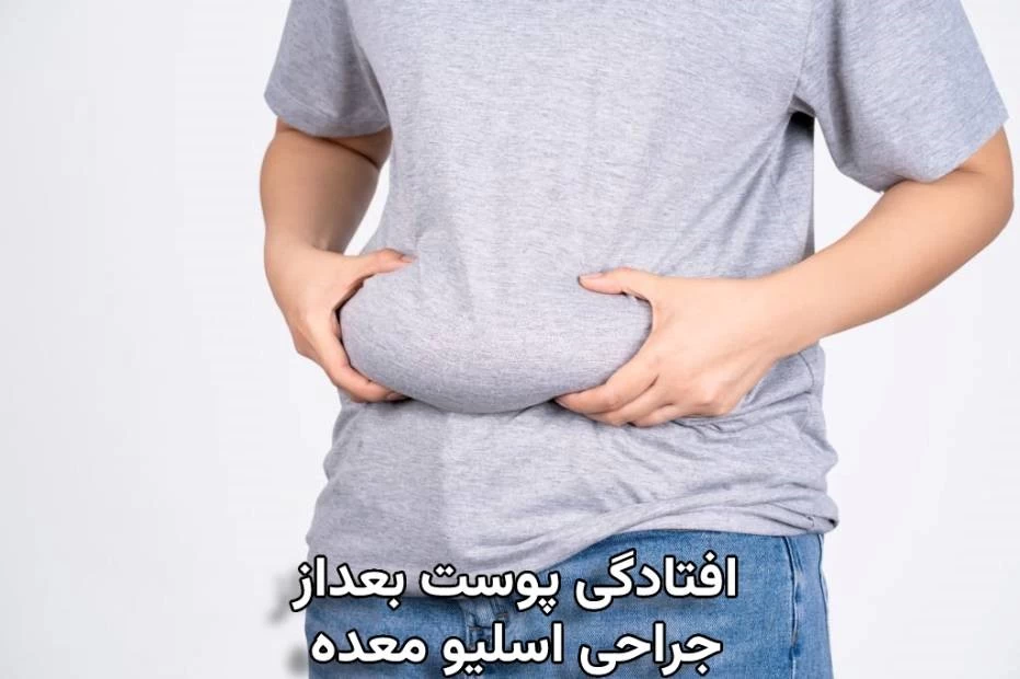پشیمانی بعد از عمل اسلیو معده براساس نظرات و تجربیات کسانی که عمل اسلیو معده انجام داده اند