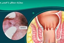 آیا شقاق یا فیشر مقعدی نیاز به درمان دارد؟ (2 نکته مهم)