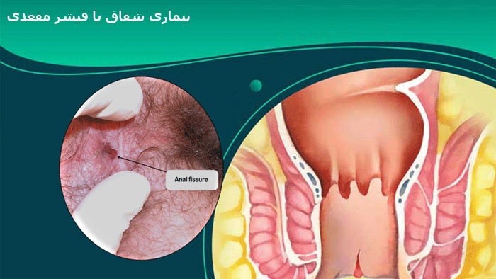 آیا شقاق یا فیشر مقعدی نیاز به درمان دارد؟ (2 نکته مهم) آیا شقاق یا فیشر مقعدی نیاز به درمان دارد؟ (2 نکته مهم)