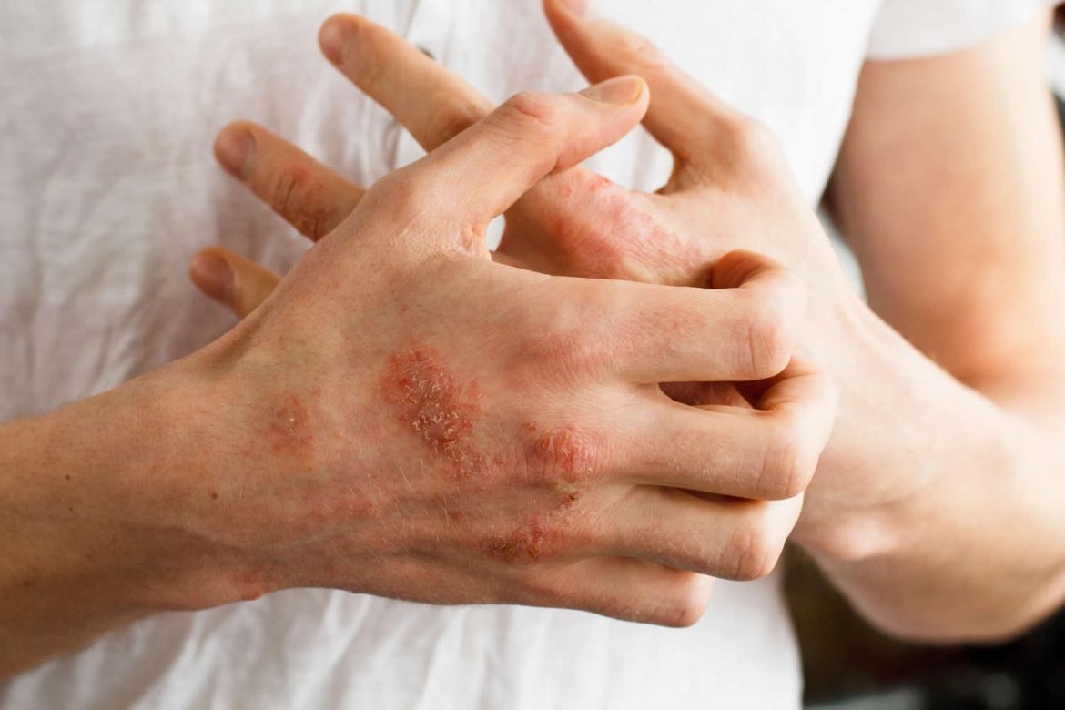علت حساسیت به لاتکس