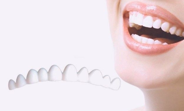 فرق لمینت ونیر کامپوزیت و روکش دندان چیست؟ (2 نکته مهم) فرق لمینت ونیر کامپوزیت و روکش دندان چیست؟ (2 نکته مهم)