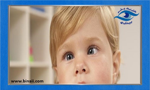 انواع انحراف چشم یا استرابیسم در کودکان