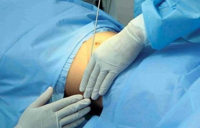 پیکرتراشی؛ روشی کم خطر برای لاغری سریع (2 نکته مهم)