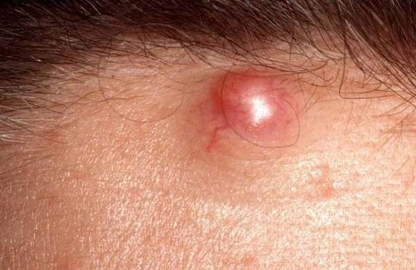 آبسه چند نوع است ؟ چگونه تشخیص و درمان میشود ؟ (2 نکته مهم)