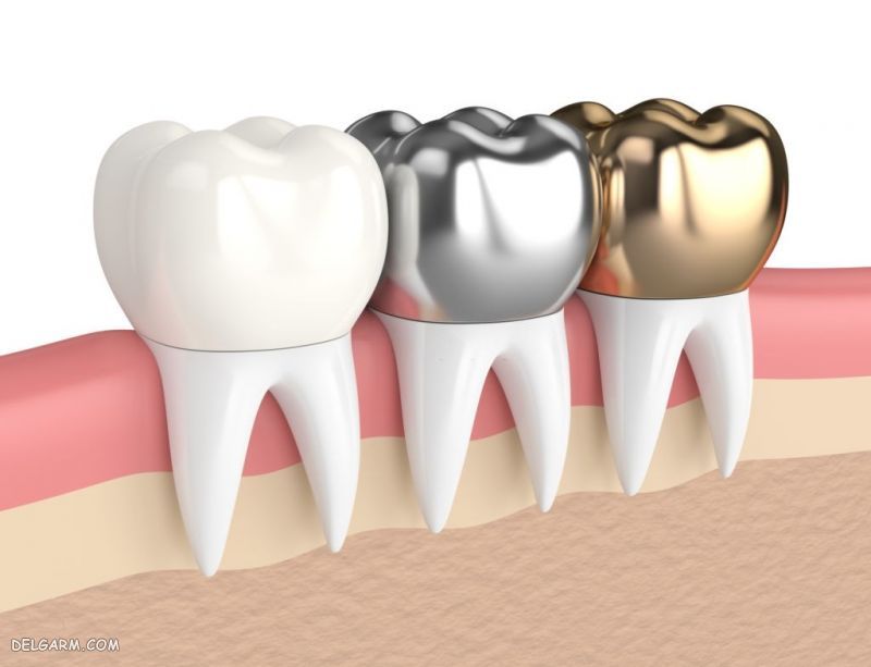 روکش دندان Dental crown