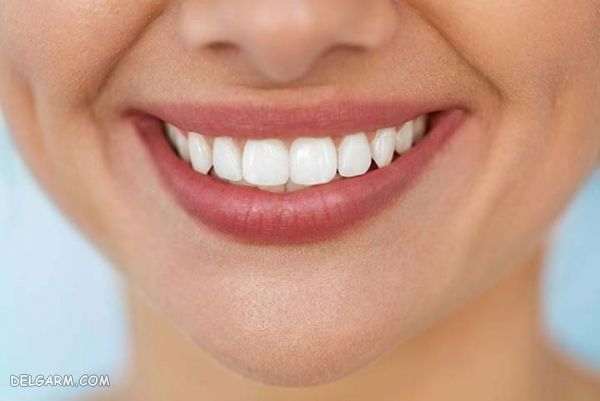 طراحی لبخند توسط سیستم لمینت